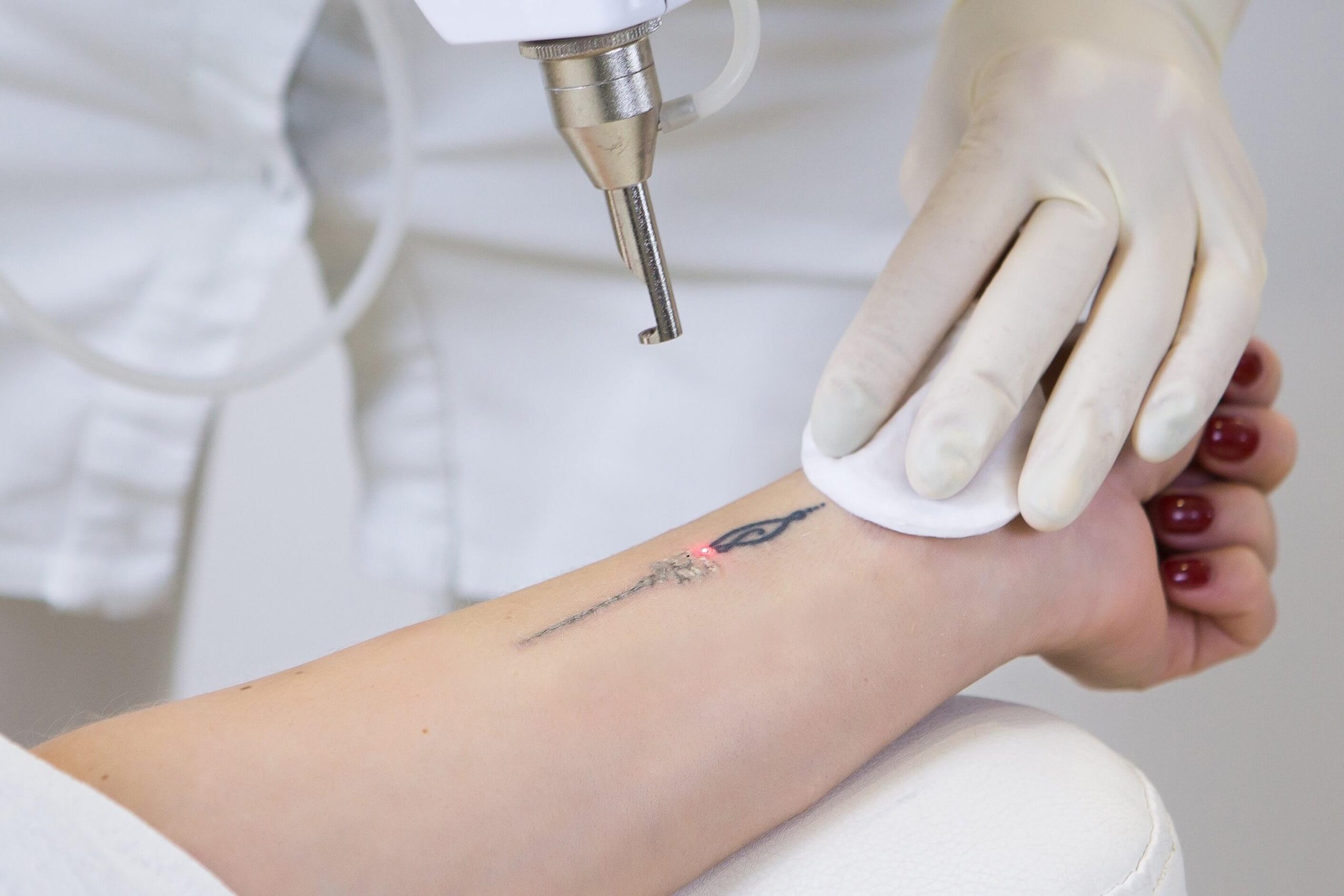 Laser Tattoo Removal  Grace Skincare Clinic