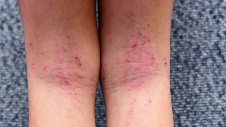 atopic dermatitis treatment