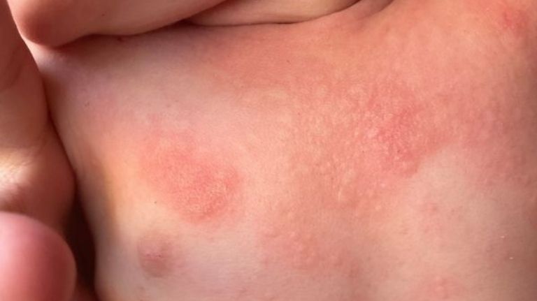 atopic dermatitisin children